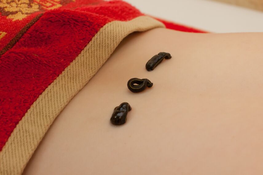 đỉa ở lưng dưới bị hoại tử xương