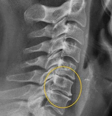 xương cổ tử cung