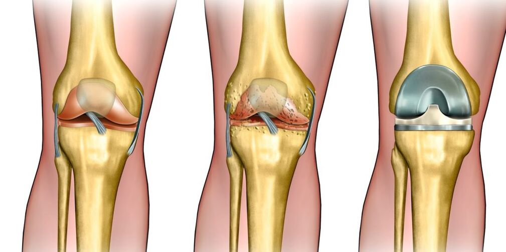 Arthrosis của khớp gối